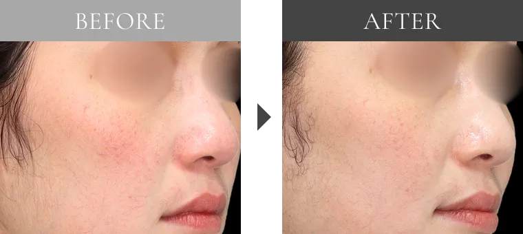 ダウンタイムが少ない赤み治療が可能