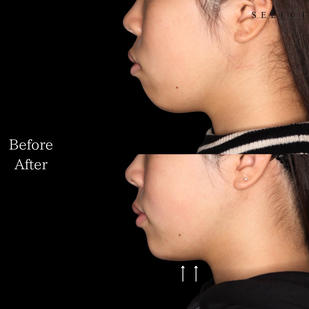 施術前後の顔の違い