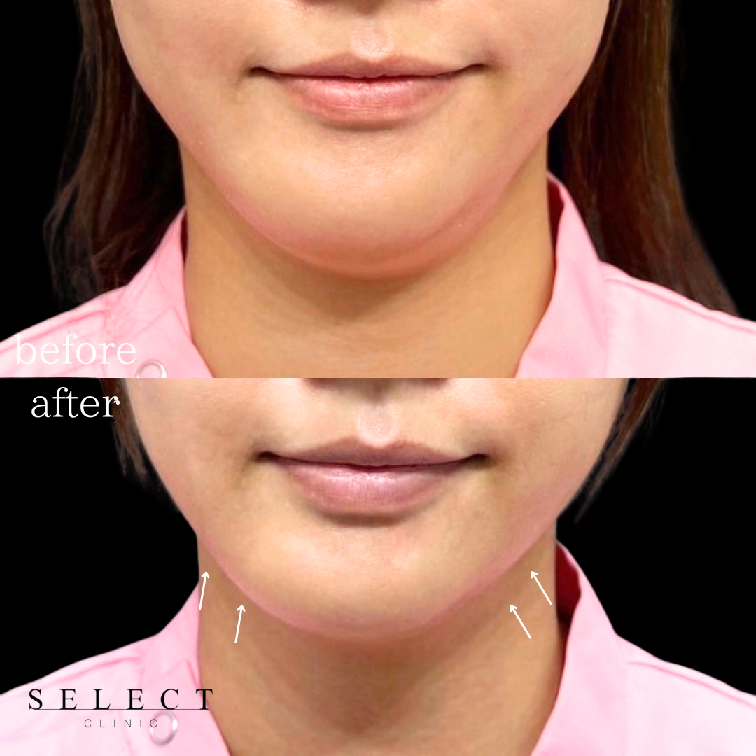 施術前後の顔の違い