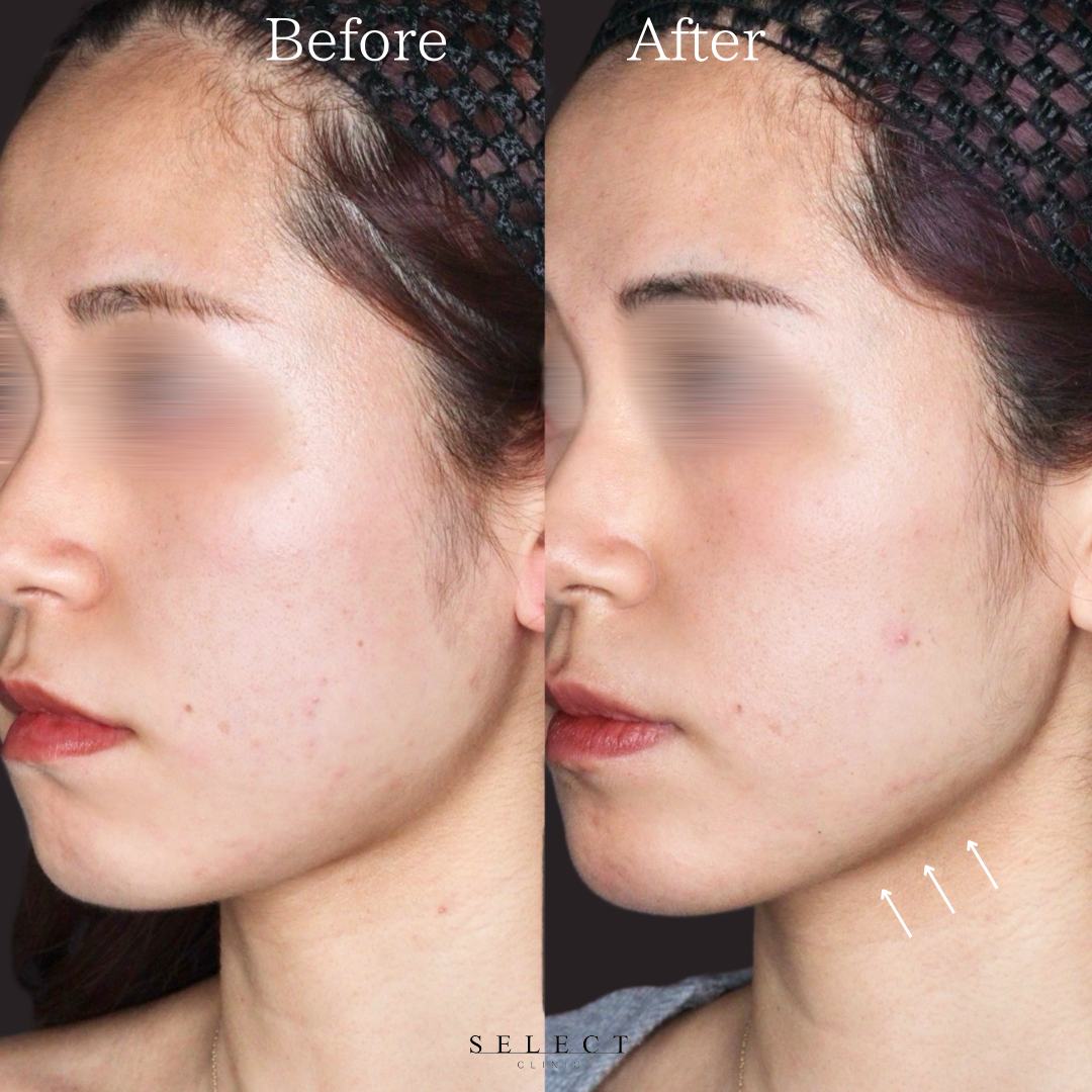 施術前後の顔の違い