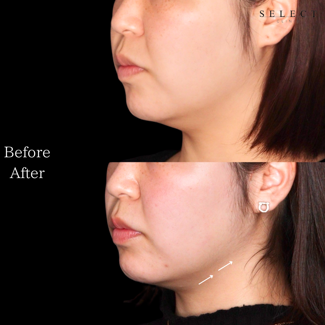 施術前後の顔の違い