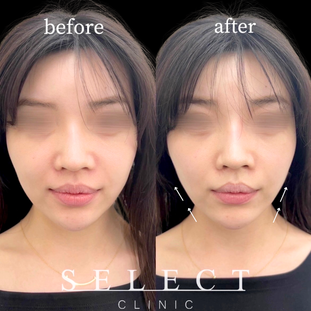 施術前後の顔の違い