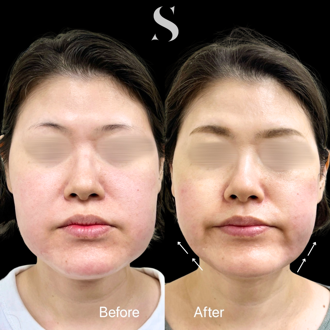 施術前後の顔の違い