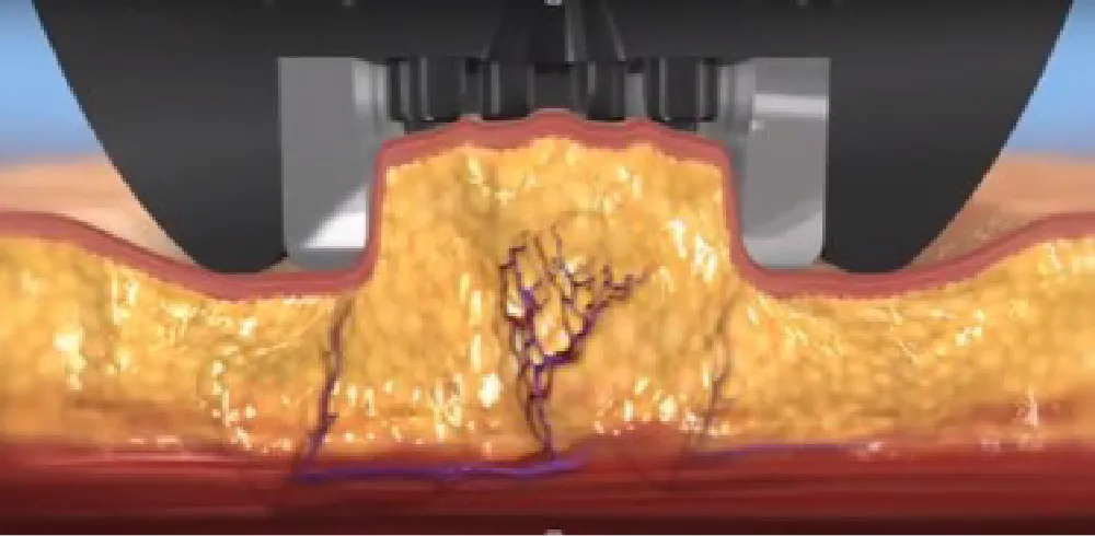 肌に機械をあてる