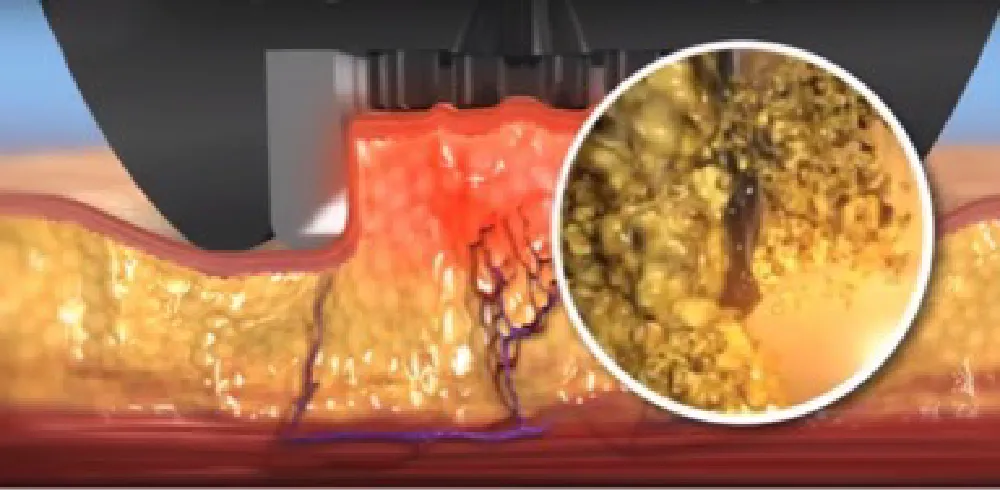 高周波で細胞を破壊する