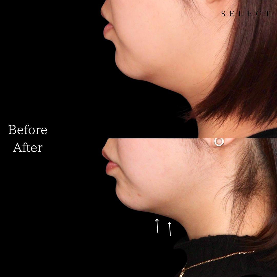 施術前後の顔の違い