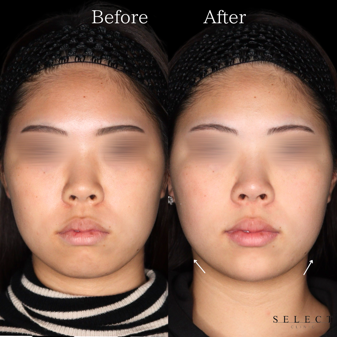 施術前後の顔の違い