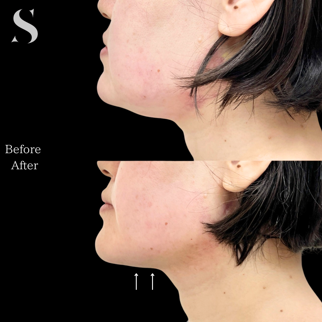 施術前後の顔の違い