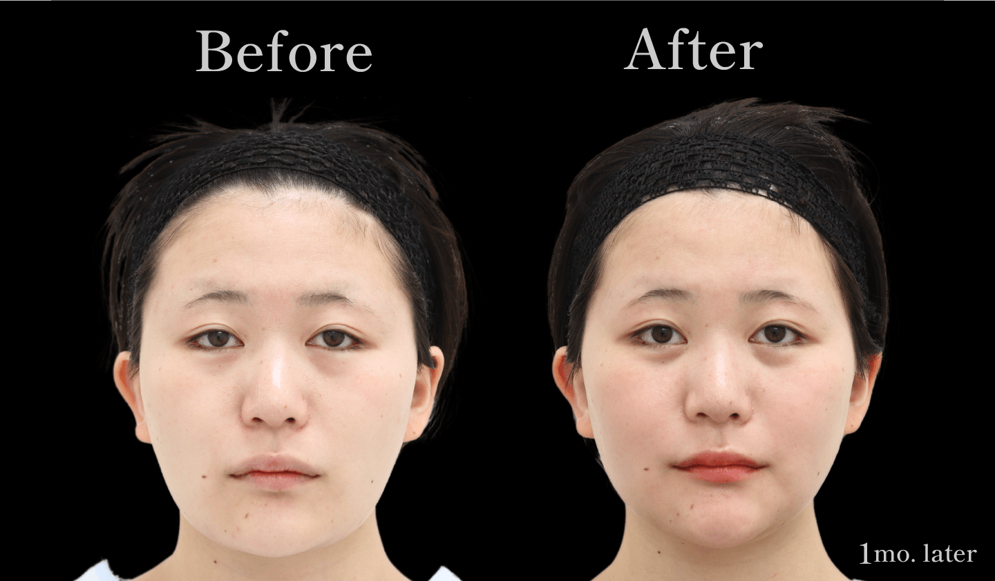 【正面】輪郭3点(頬骨・エラ・アゴ)