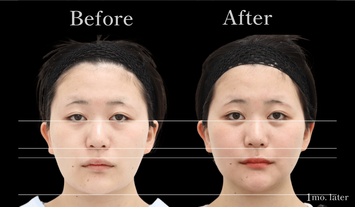 【正面】輪郭3点(頬骨・エラ・アゴ)