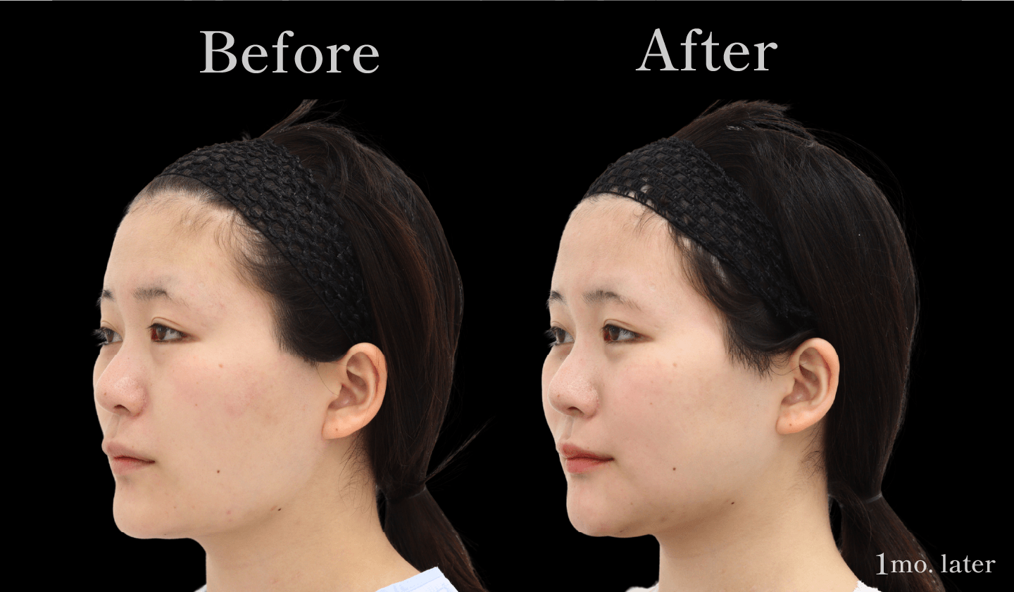 【側面】輪郭3点(頬骨・エラ・アゴ)