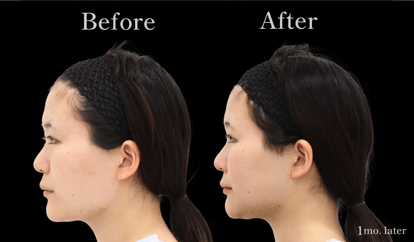 【側面】輪郭3点(頬骨・エラ・アゴ)