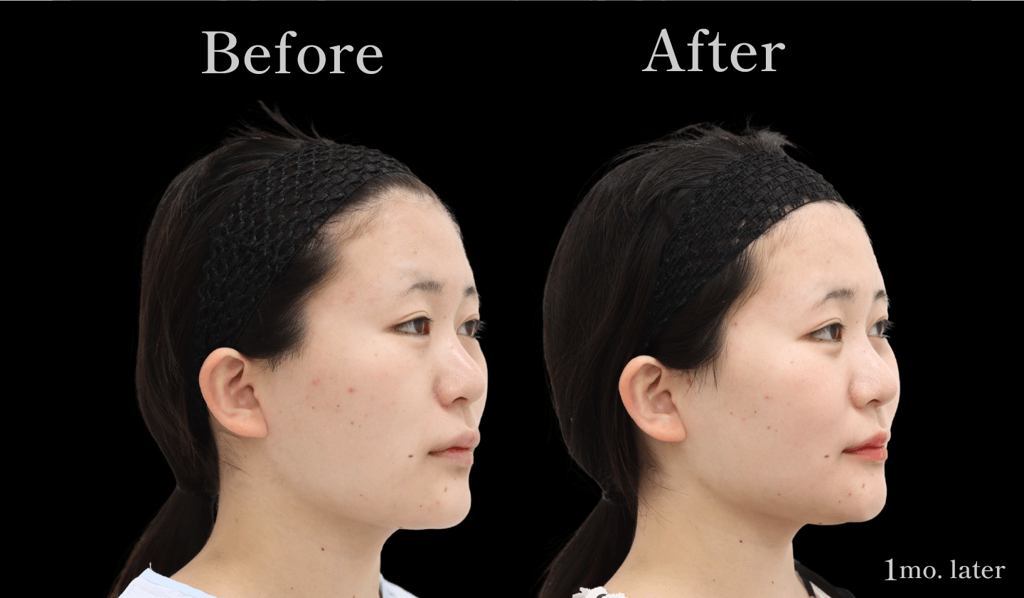 【側面】輪郭3点(頬骨・エラ・アゴ)