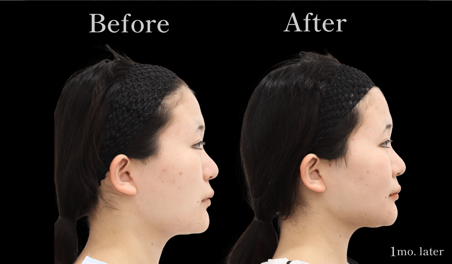 【側面】輪郭3点(頬骨・エラ・アゴ)