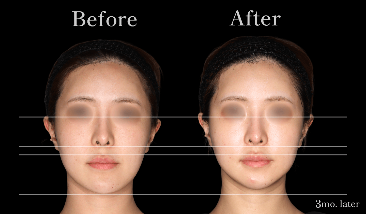 【正面】Vライン形成（エラ・アゴ）