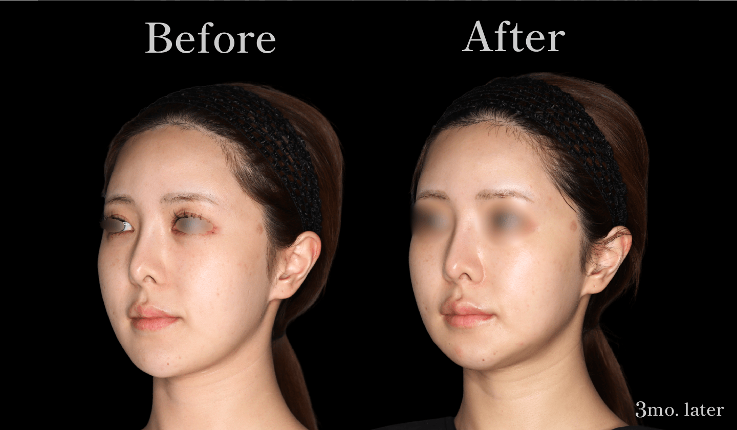 【側面】Vライン形成（エラ・アゴ）