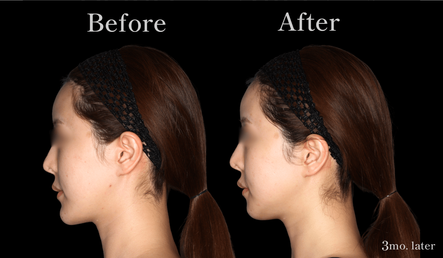 【側面】Vライン形成（エラ・アゴ）