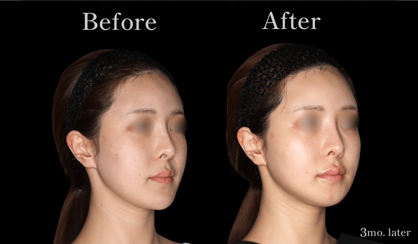 【側面】Vライン形成（エラ・アゴ）