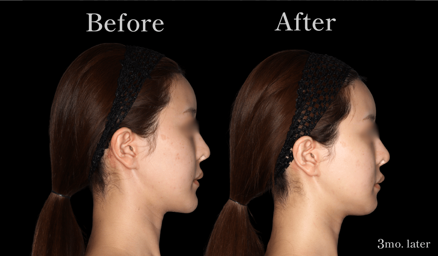 【側面】Vライン形成（エラ・アゴ）