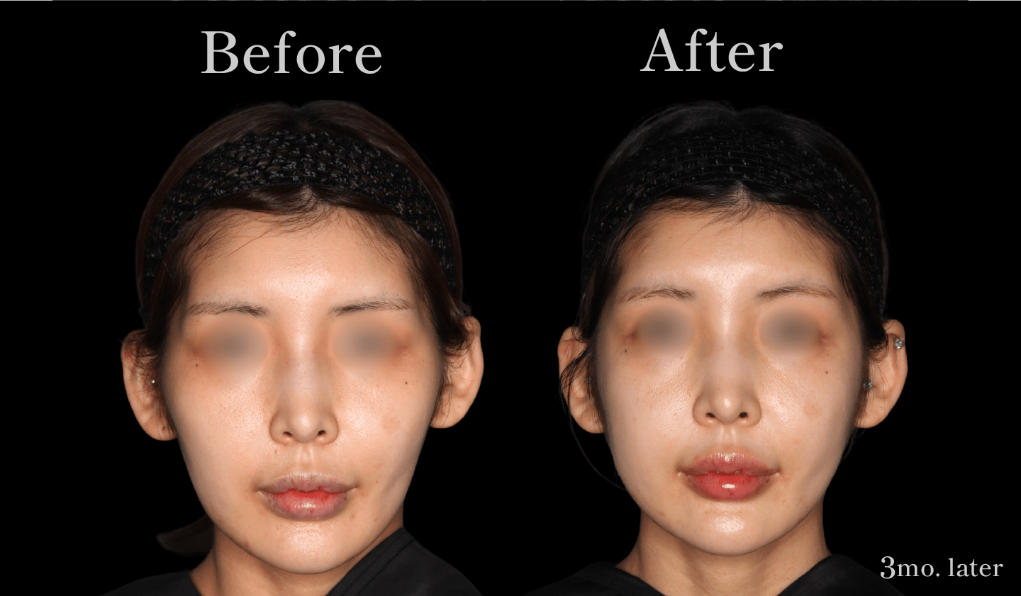 【正面】頬骨セットバック