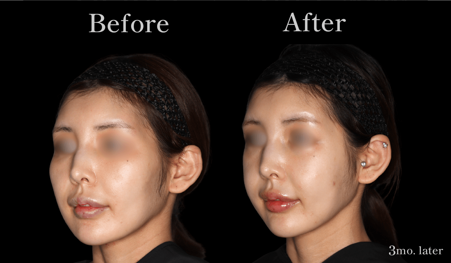 【正面】頬骨セットバック