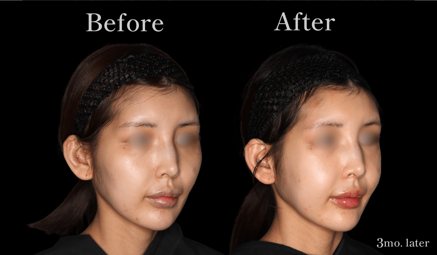 【側面】頬骨セットバック