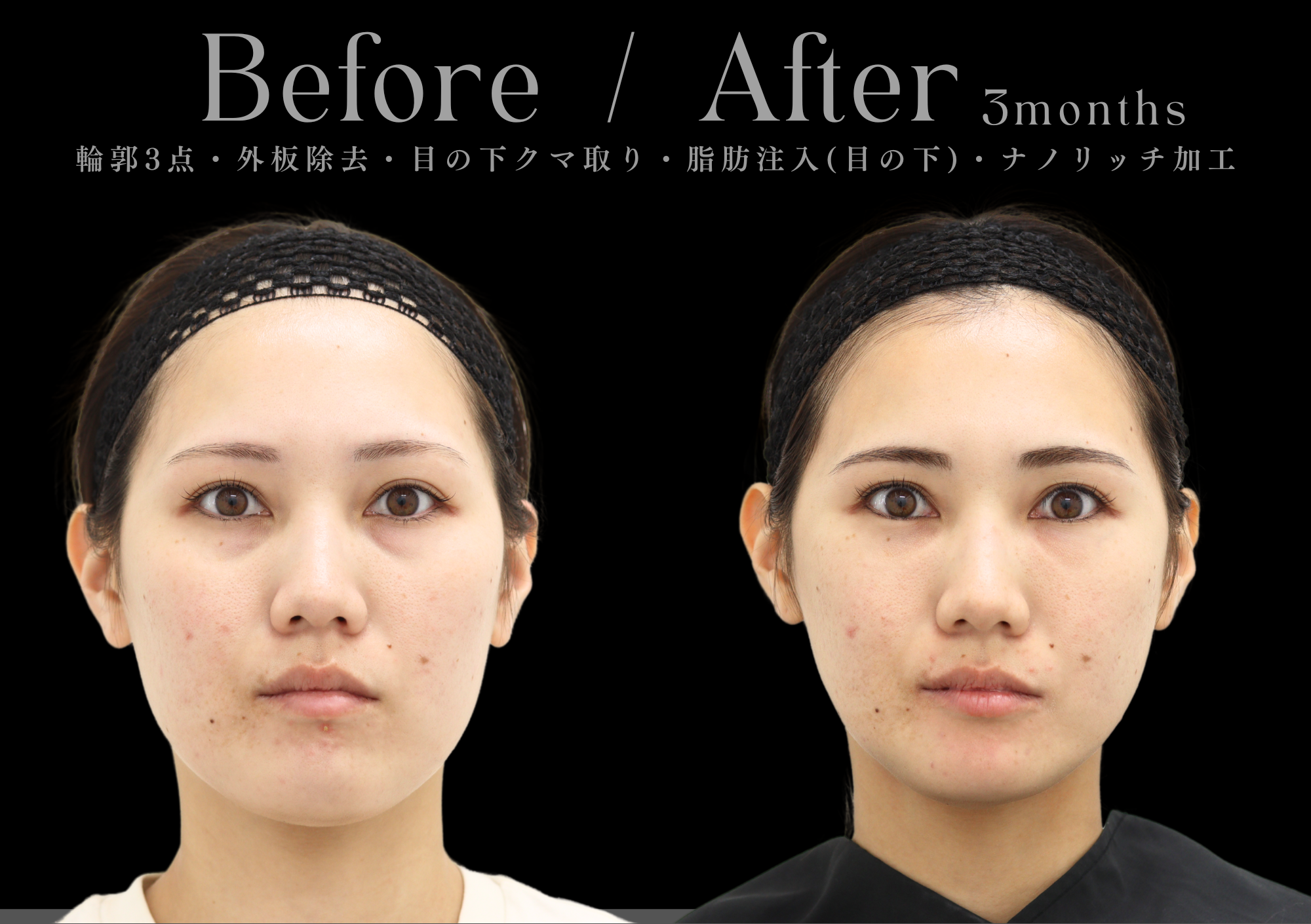 【正面】輪郭3点(頬骨・エラ・オトガイ)