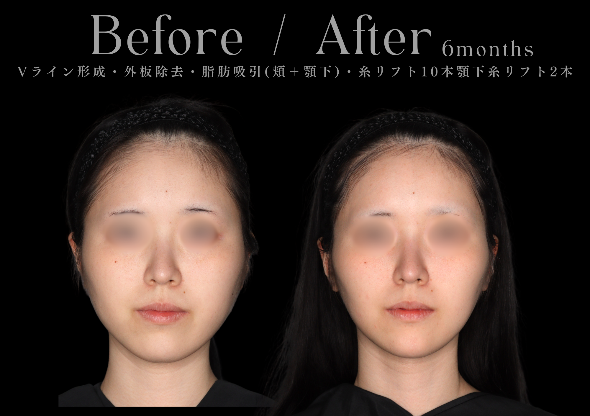 【背面】輪郭3点(頬骨・エラ・オトガイ)