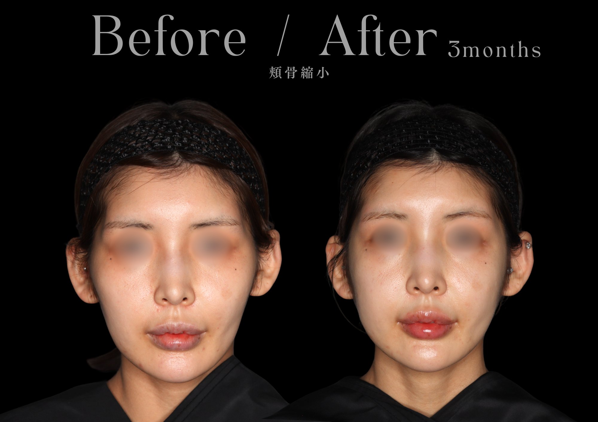 【背面】輪郭3点(頬骨・エラ・オトガイ)