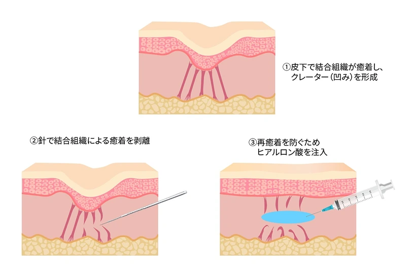 施術のイラスト図