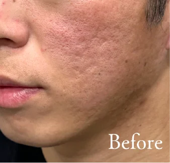 施術前の頬の様子