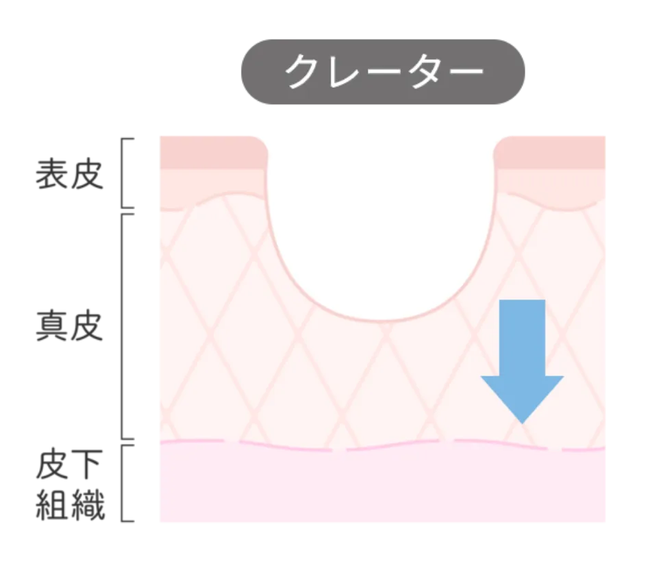 クレーター肌の内部の説明