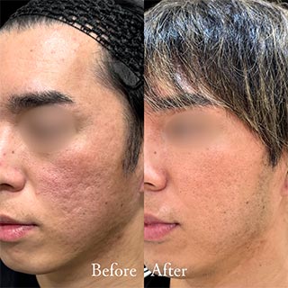 施術前後の肌の違い