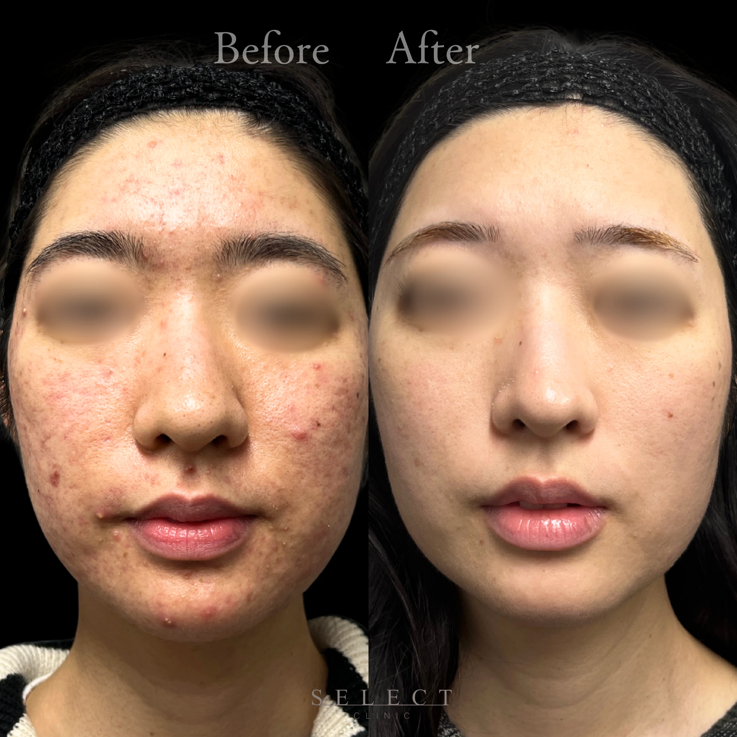 施術前後の肌の違い