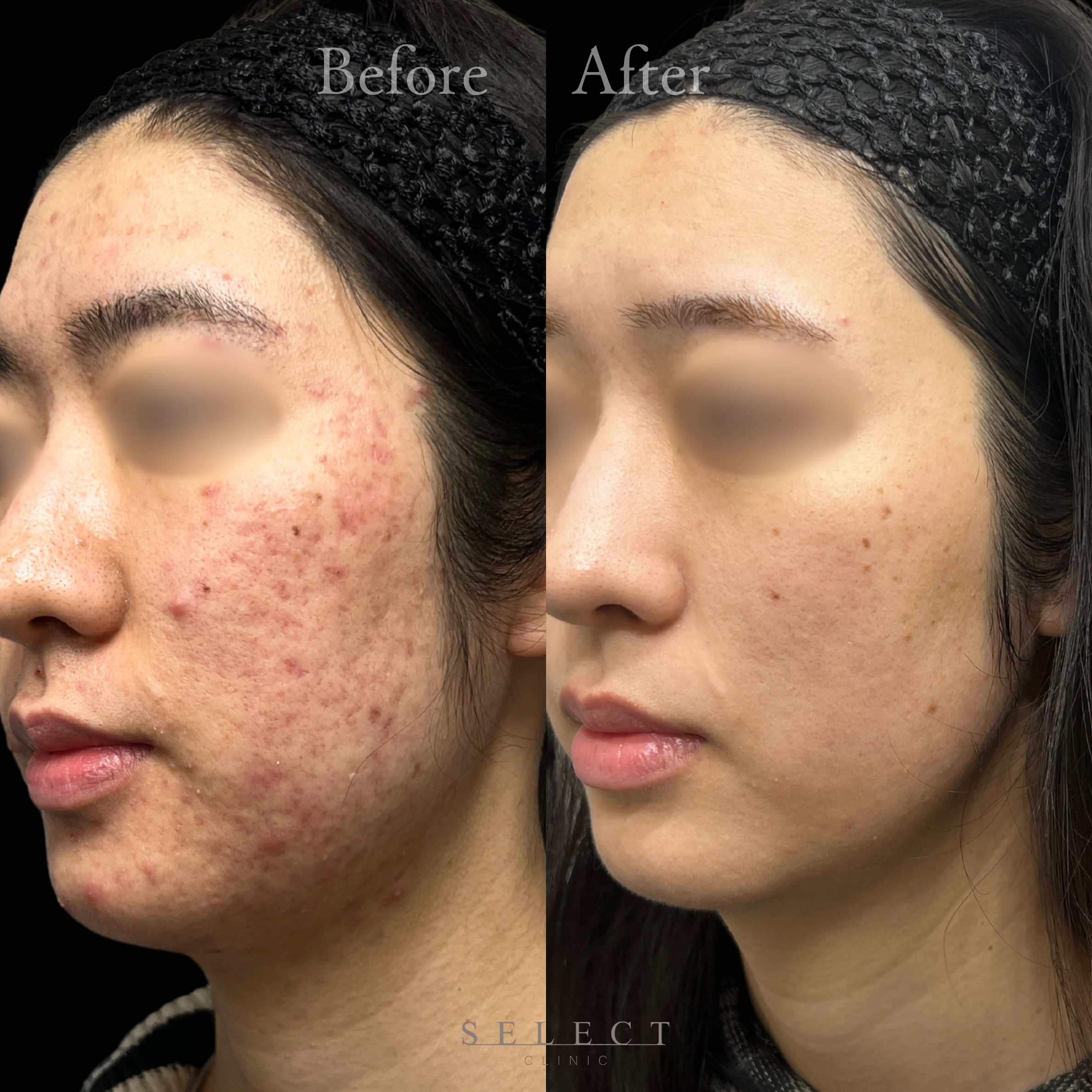 施術前後の肌の違い2