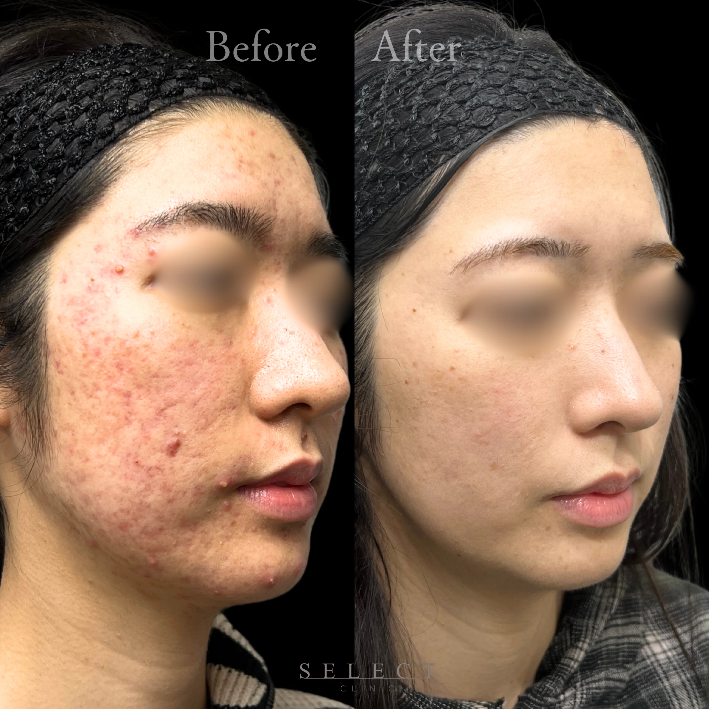 施術前後の肌の違い3