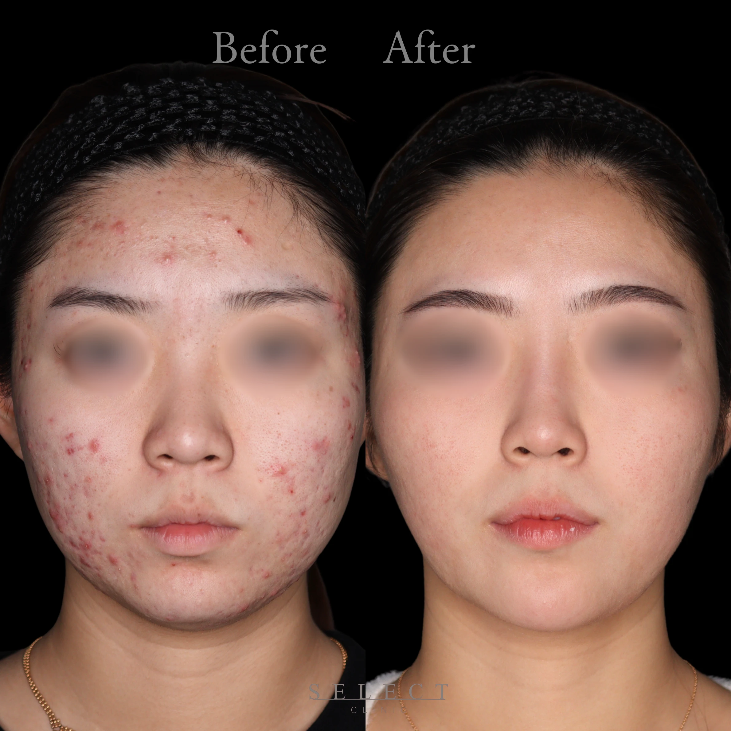 施術前後の肌の違い