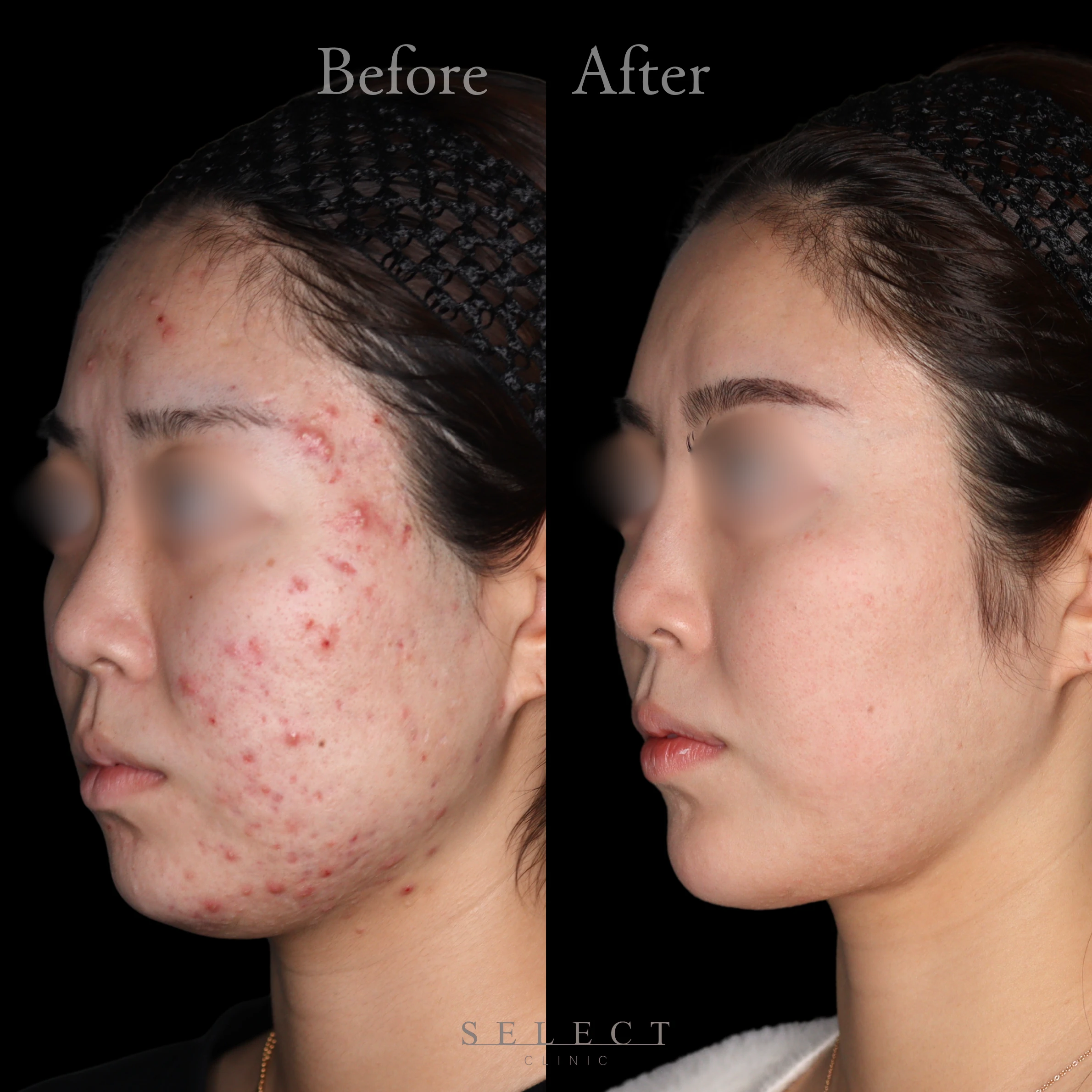 施術前後の肌の違い2