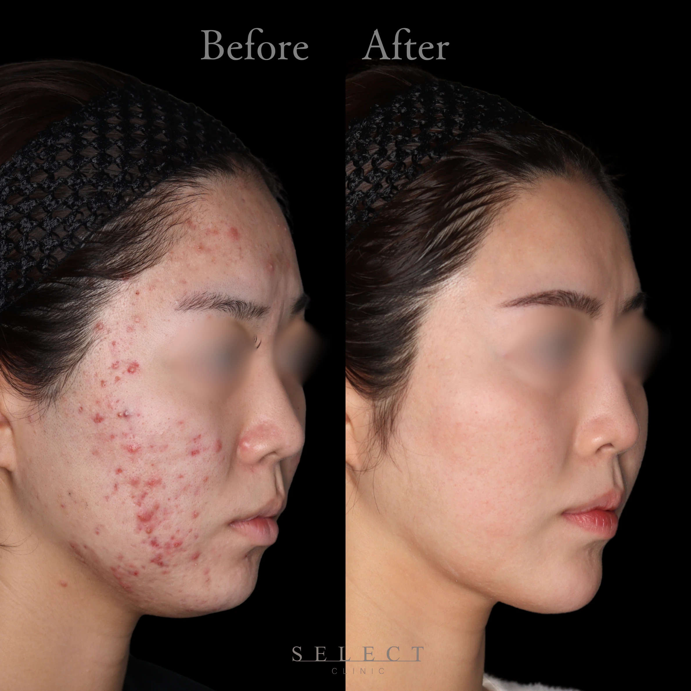 施術前後の肌の違い3