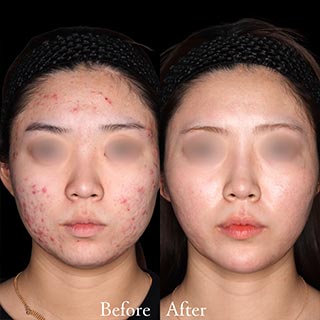 施術前後の肌の違い