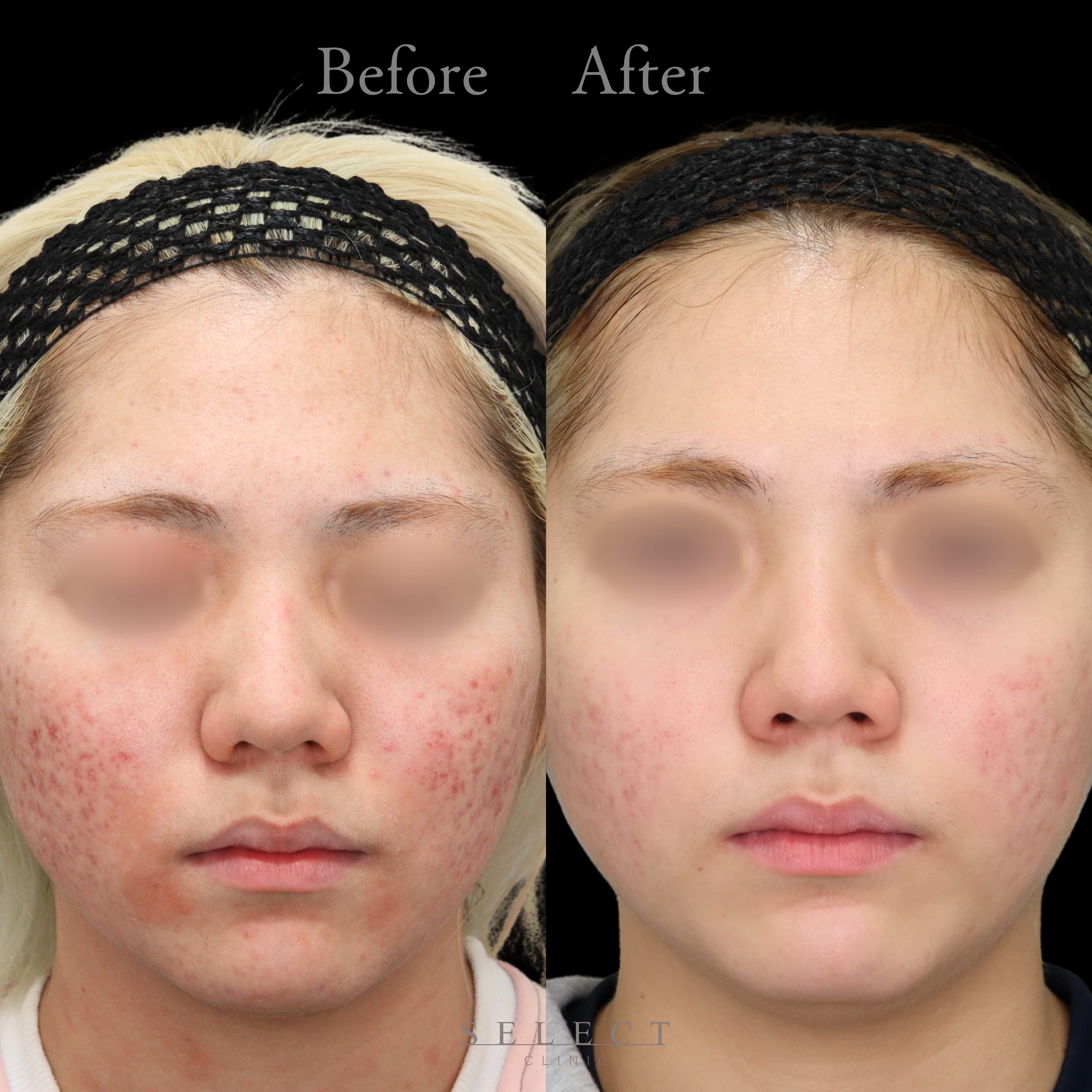 施術前後の肌の違い