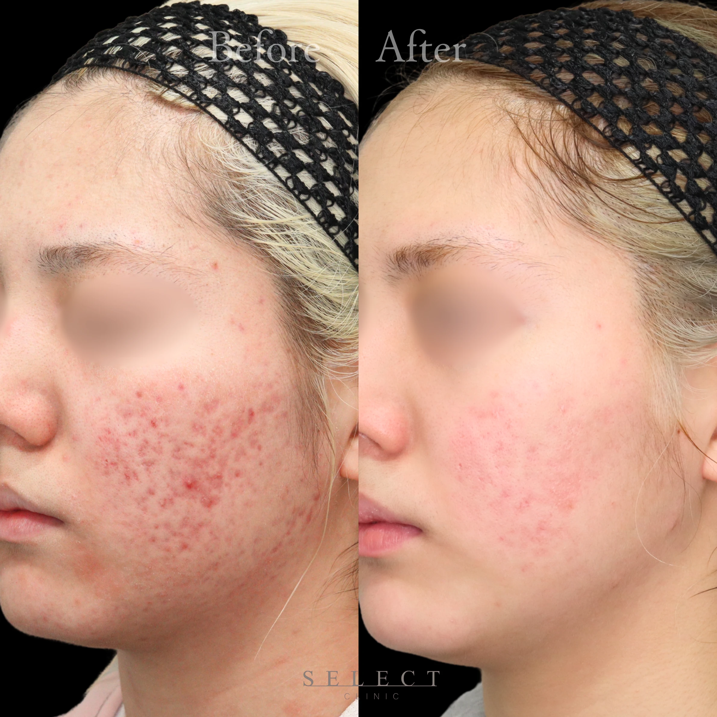 施術前後の肌の違い2