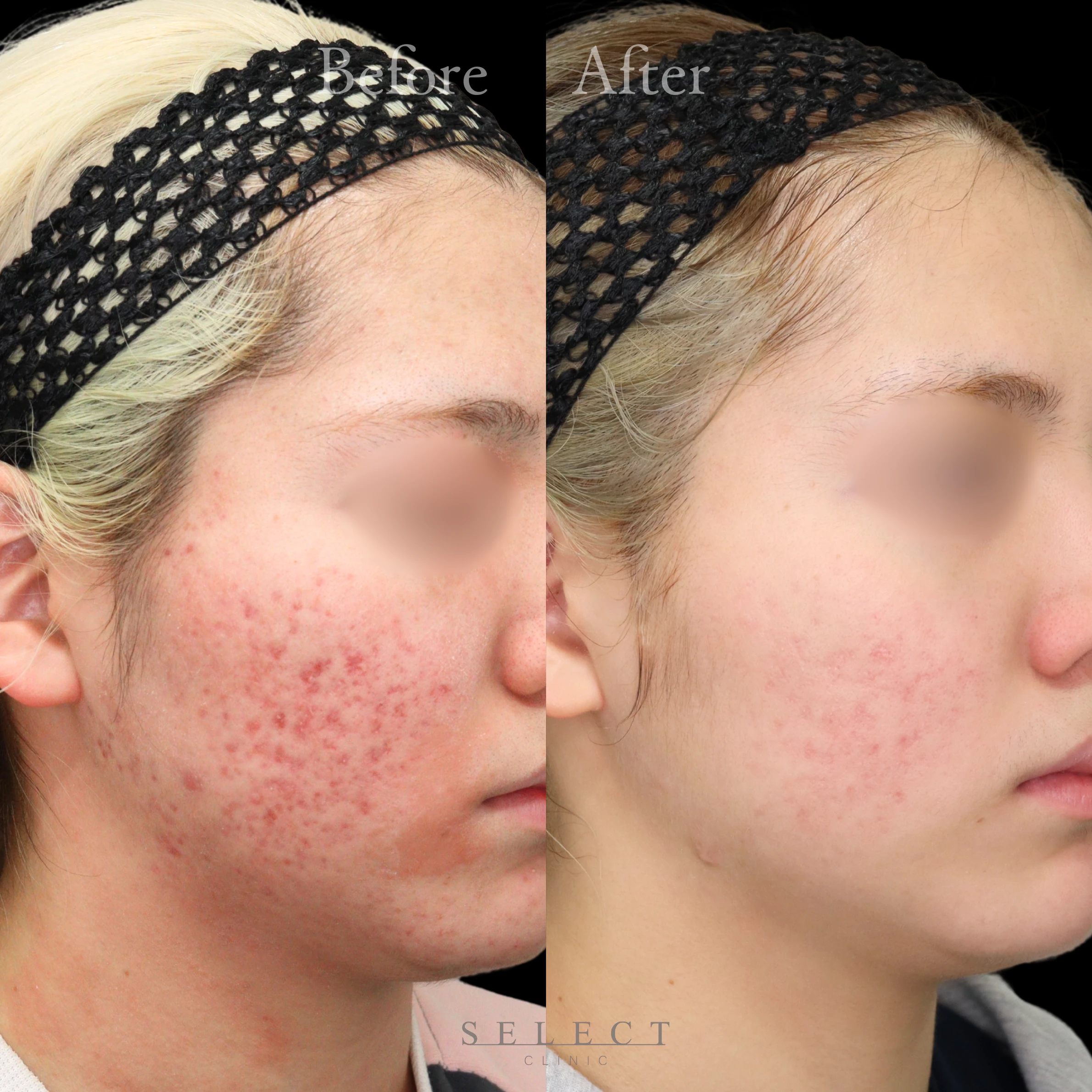 施術前後の肌の違い3