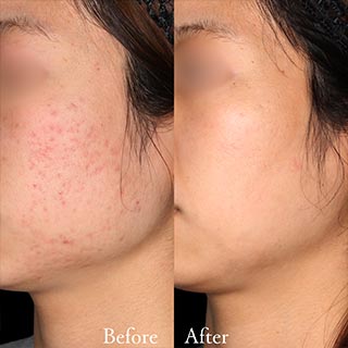 施術前後の肌の違い