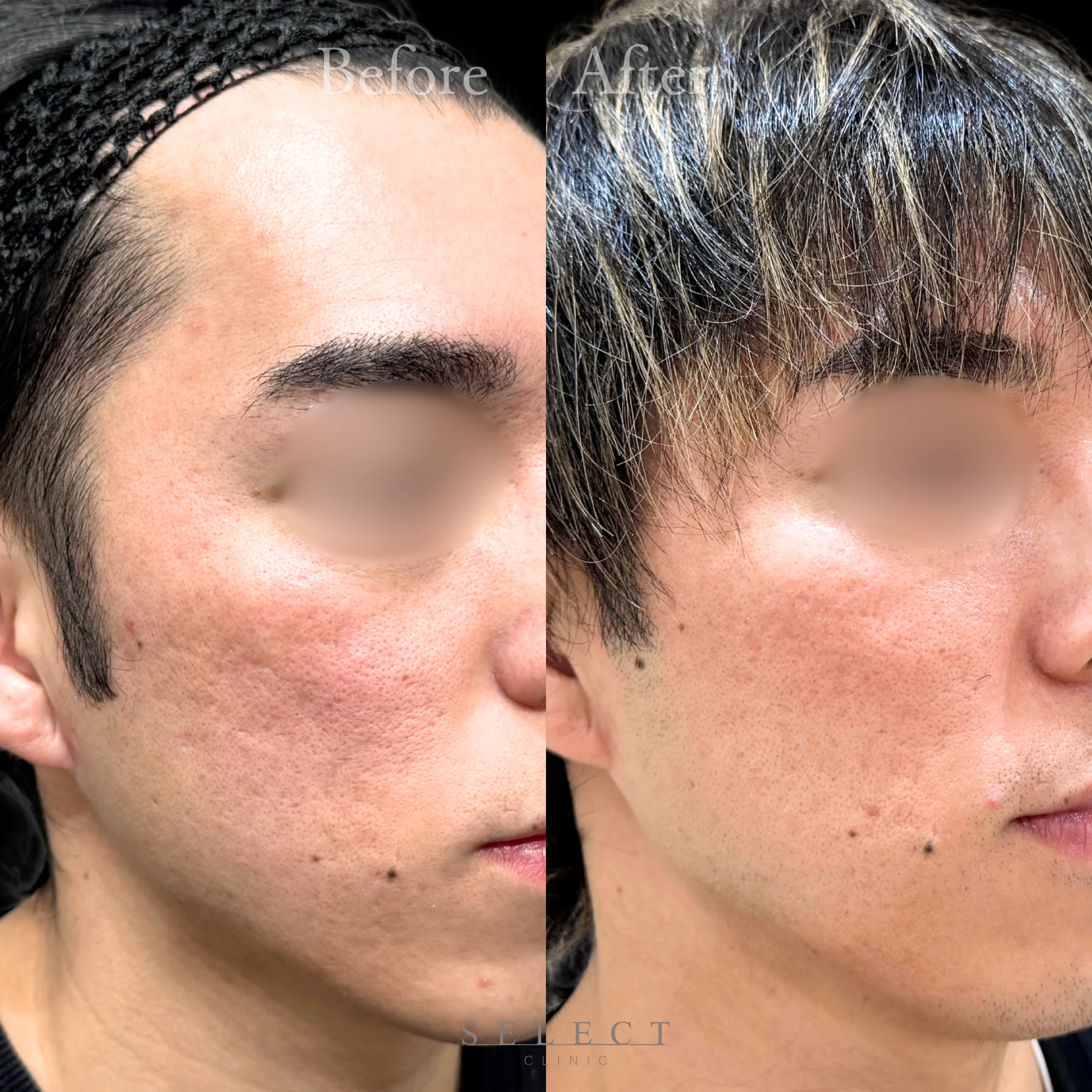 施術前後の肌の違い