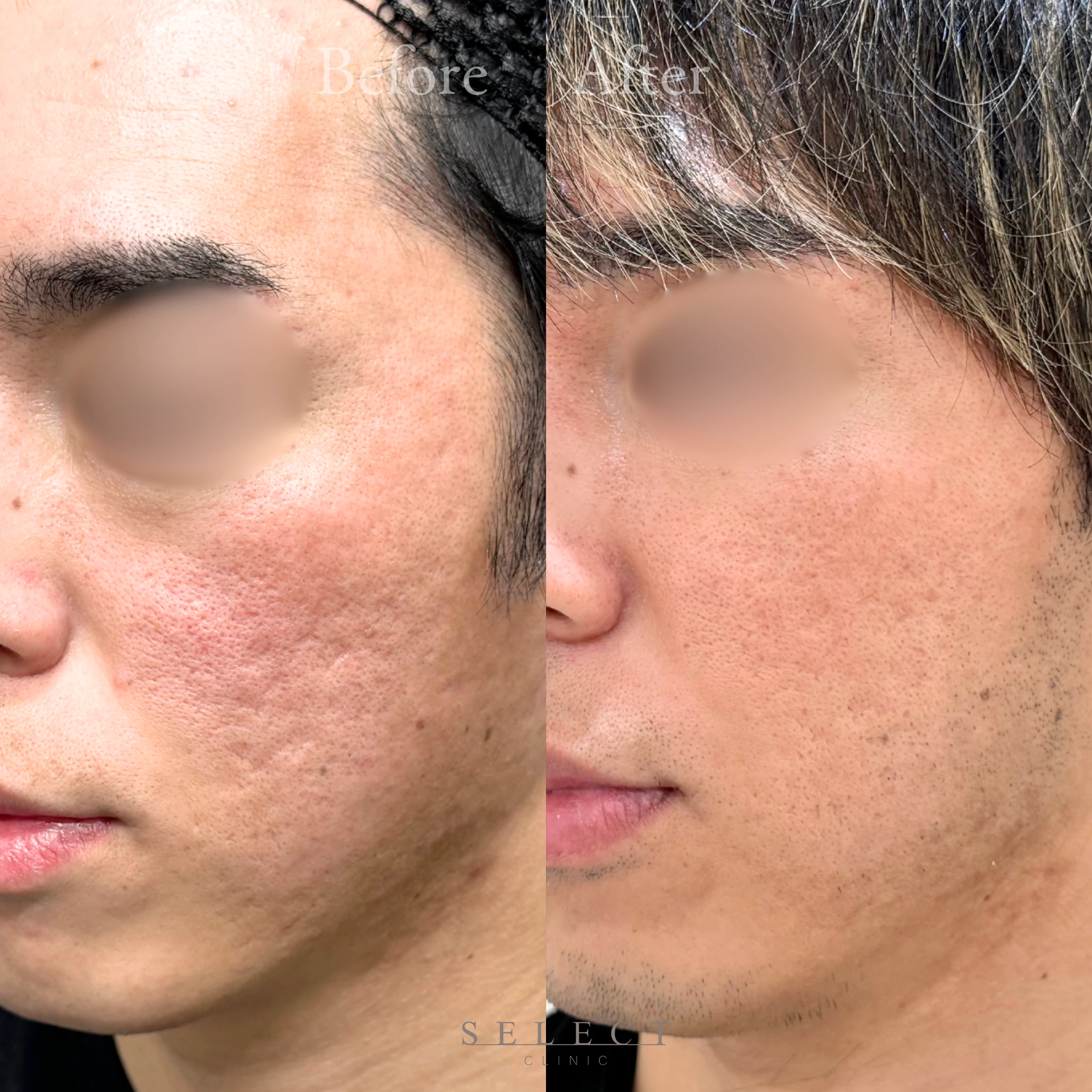 施術前後の肌の違い2