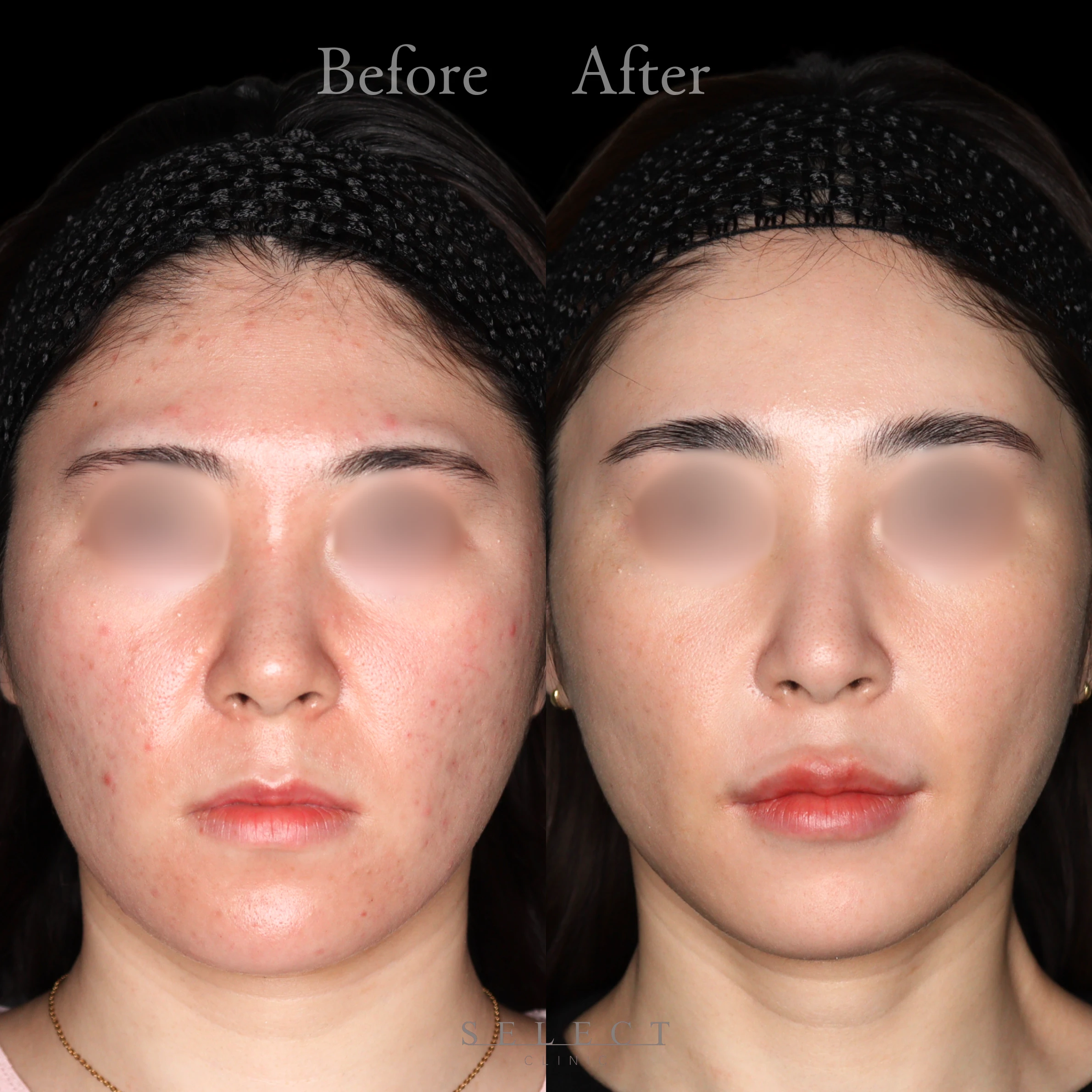 施術前後の肌の違い