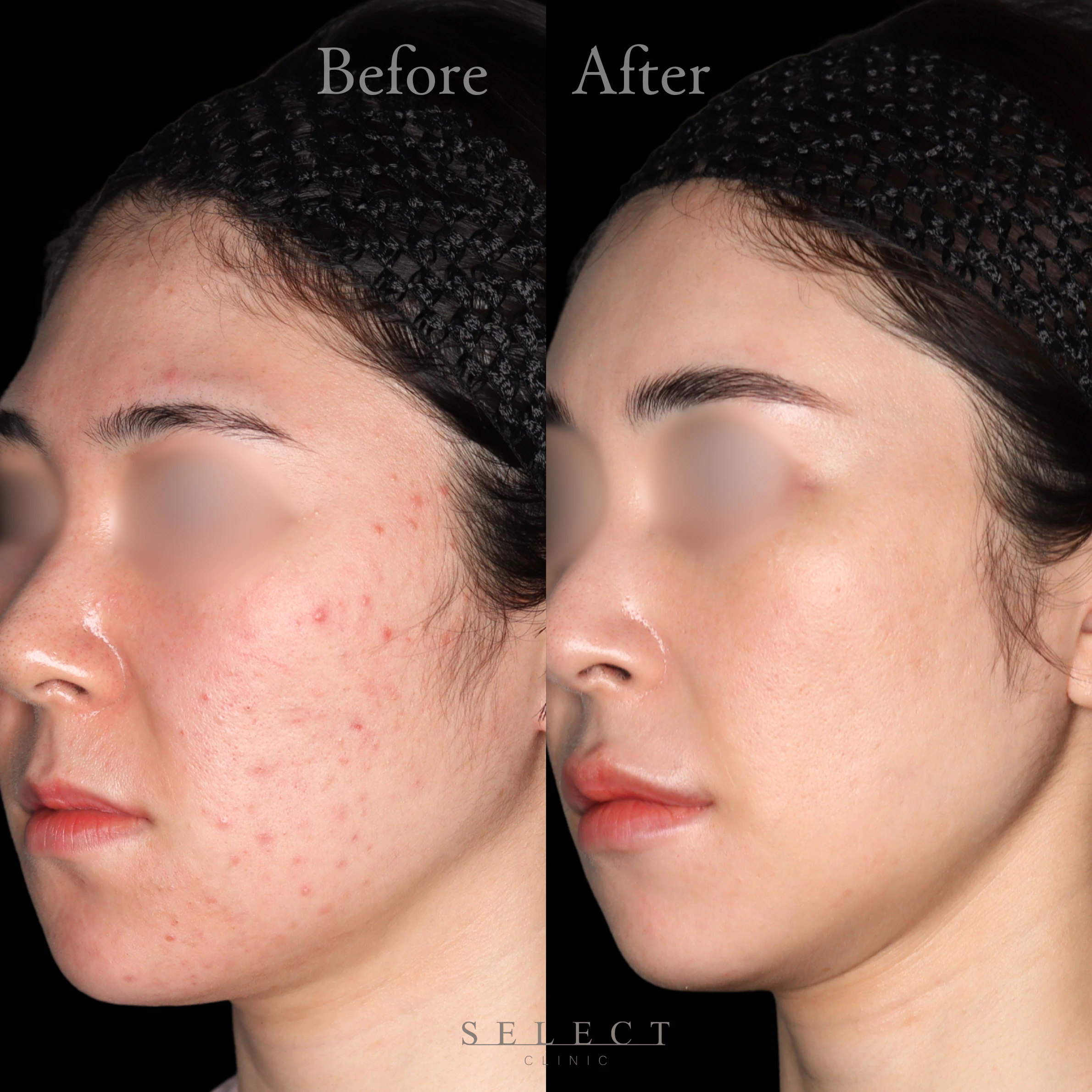 施術前後の肌の違い2