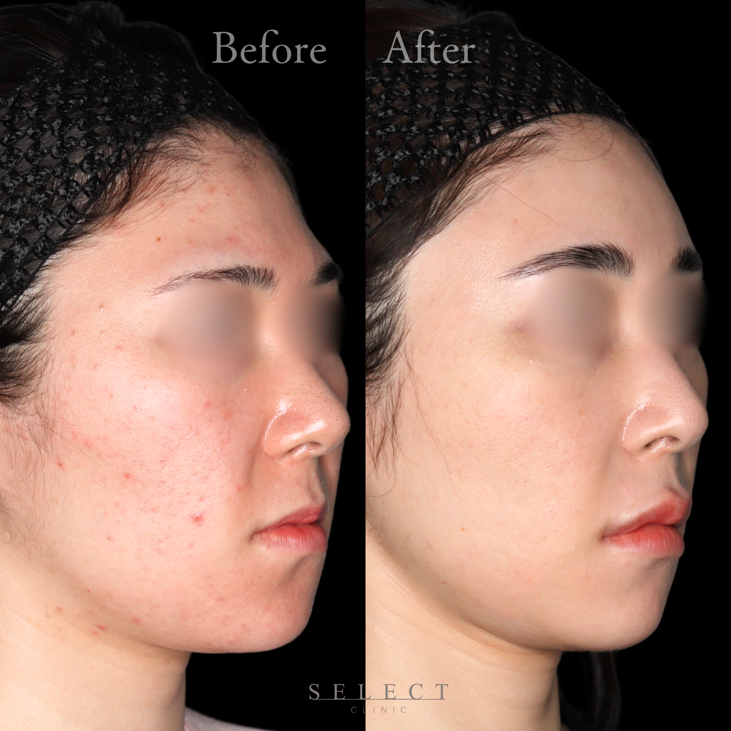 施術前後の肌の違い3