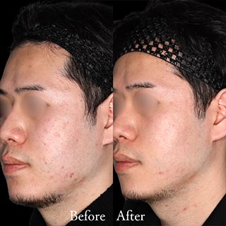 施術前後の肌の違い